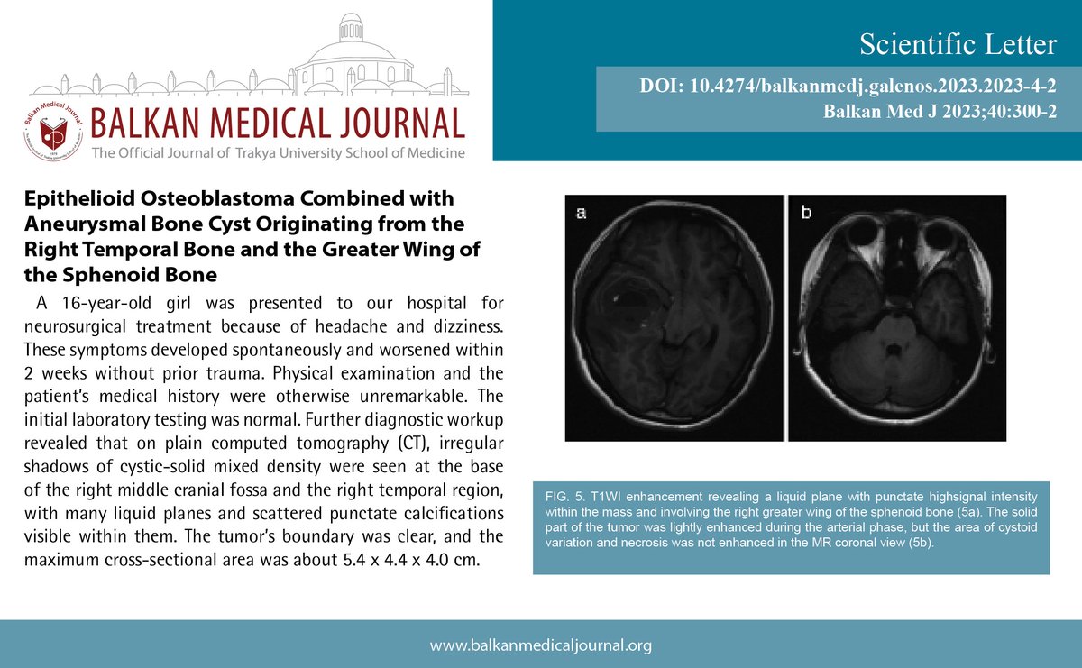 Epithelioid Osteoblastoma Combined with Aneurysmal Bone Cyst Originating from the Right Temporal Bone and the Greater Wing of the Sphenoid Bone
You can see the free full text of the research by Peng An et al.
Link : balkanmedicaljournal.org/uploads/pdf/pd…