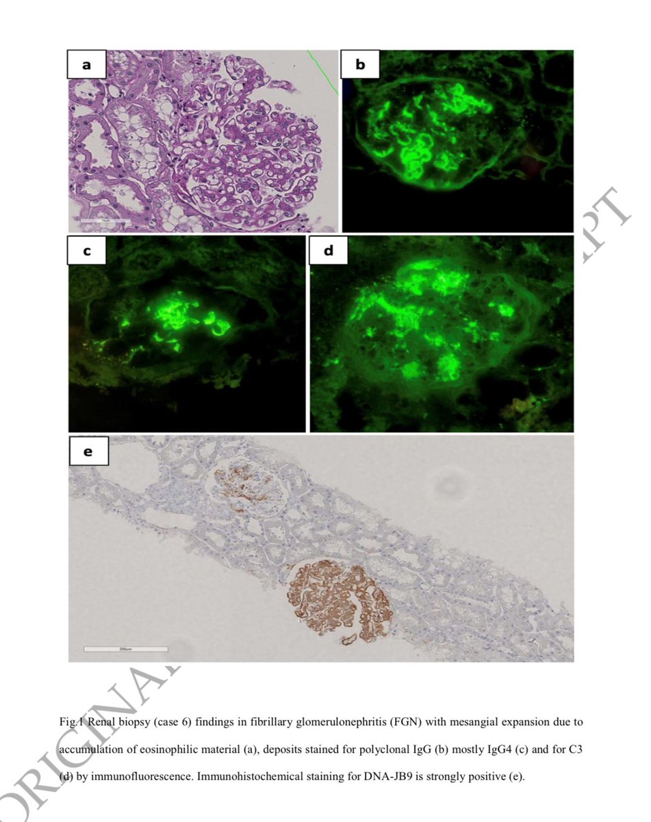 👍🫘Managing Fibrillary GN with B cell depletion therapy

academic.oup.com/ndt/advance-ar… 

<a href="/NDTsocial/">NDT</a> <a href="/hjanders_hans/">Hans-Joachim Anders</a>