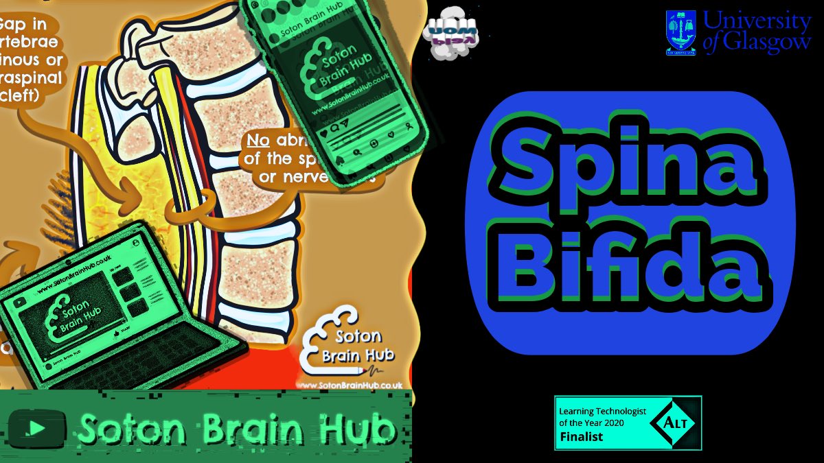 Scott Border (@scottborder1) on Twitter photo Spina Bifida
youtu.be/ZekpNxBxRJU
New video alert🎬🎥📺 <a href="/UofG_Anatomy/">Anatomy@UofG</a> <a href="/calvindelouche/">Calvin De Louche</a> <a href="/charlottewoody_/">charlotte</a> <a href="/anat_soc/">Anatomical Society</a> <a href="/anat_sci_UoE/">Anatomical Sciences Edinburgh</a> Spina Bifida
youtu.be/ZekpNxBxRJU
New video alert🎬🎥📺 <a href="/UofG_Anatomy/">Anatomy@UofG</a> <a href="/calvindelouche/">Calvin De Louche</a> <a href="/charlottewoody_/">charlotte</a> <a href="/anat_soc/">Anatomical Society</a> <a href="/anat_sci_UoE/">Anatomical Sciences Edinburgh</a>