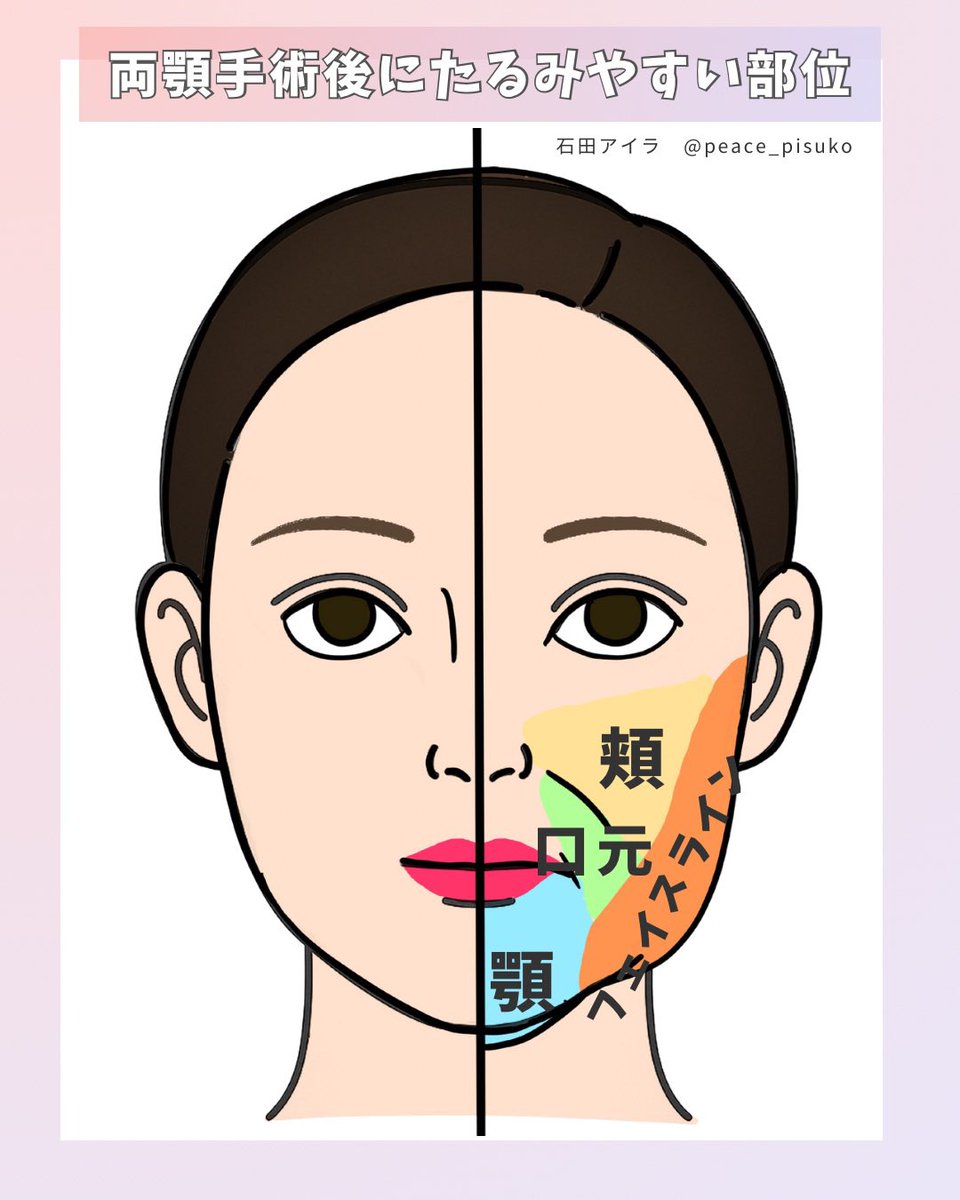 peace_pisuko's tweet photo. 両顎手術が成功＝完成じゃなくて、たるみが1番の大敵🤦‍♀️

『たるみやすい部位』
・頬
・フェイスライン
・口元
・顎（二重顎）

両顎手術は骨、筋肉、皮膚、神経、全部が一度バラバラになるので、顔がたるむのは当たり前で、その後のケアが大事💪✨
とにかく表情筋を動かす！真顔のまま🆖
#顎変形症 https://t.co/PEQpfF5Kgt