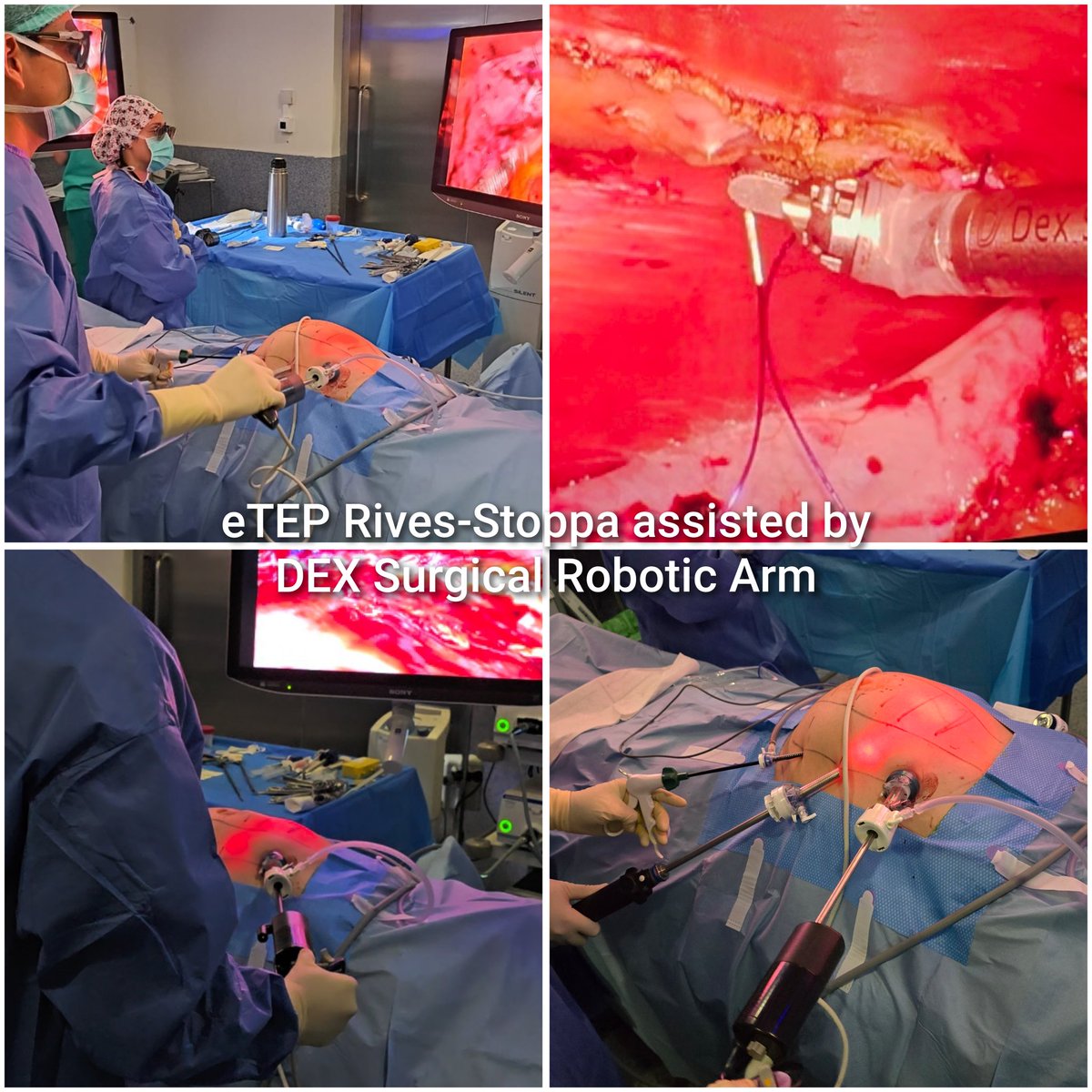 S. de Cir. General - Hospital de Medina del Campo (@cgdmedina) on Twitter photo 🔝eTEP laparoscópico Nº 117 ✅
Ahora con asistencia del brazo robótico DEX Surgical 🤖 <a href="/DexSurgical/">Dex Surgical</a> <a href="/CardiolinkSL/">Cardiolink Group</a>
Cirugía cada vez más precisa, ergonómica y Mínimamente invasiva✨️
¡Innovación en <a href="/CGDMedina/">S. de Cir. General - Hospital de Medina del Campo</a>! 👏👏
#Cirugíahernia #eTEP #Laparoscopia #DEXSurgical #MínimaInvasión 🔝eTEP laparoscópico Nº 117 ✅
Ahora con asistencia del brazo robótico DEX Surgical 🤖 <a href="/DexSurgical/">Dex Surgical</a> <a href="/CardiolinkSL/">Cardiolink Group</a>
Cirugía cada vez más precisa, ergonómica y Mínimamente invasiva✨️
¡Innovación en <a href="/CGDMedina/">S. de Cir. General - Hospital de Medina del Campo</a>! 👏👏
#Cirugíahernia #eTEP #Laparoscopia #DEXSurgical #MínimaInvasión