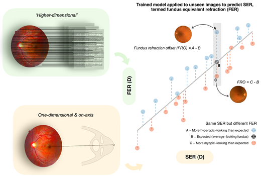 Fabian Yii et al. investigate Fundus Refraction Offset as a Personalized Biomarker for 12-Year Risk of Retinal Detachment, iovs.arvojournals.org/article.aspx?a….