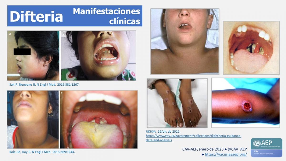 Comité Vacunas e Inmunizaciones-AEP (@cav_aep) on Twitter photo Difteria en Europa: el brote de 2022 controlado pero el riesgo persiste.
La difteria sigue siendo endémica en nuestro medio y puede dar lugar a brotes epidémicos en regiones donde la cobertura vacunal es subóptima.
vacunasaep.org/profesionales/… Difteria en Europa: el brote de 2022 controlado pero el riesgo persiste.
La difteria sigue siendo endémica en nuestro medio y puede dar lugar a brotes epidémicos en regiones donde la cobertura vacunal es subóptima.
vacunasaep.org/profesionales/…