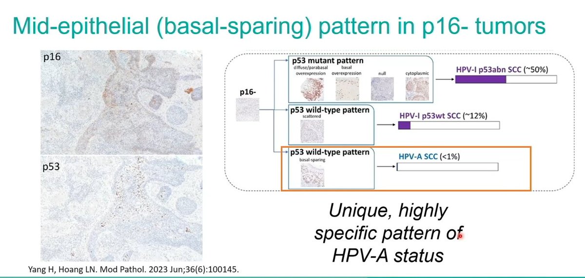 Pitfalls in vulvar SCC classification by p16 and p53

Mid-epithelial (basal sparing) staining pattern of p53 in p16 negative  tumors
This is rare- Unique highly specific pattern of HPV associated status

Dr. Rakislova #USCAP25 #pathology #PathX