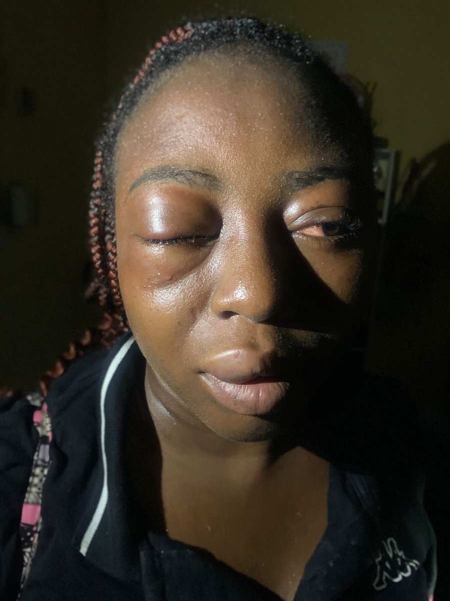 Yesterday, i was robbed and battered by 4 men. All i did wrong was leaving my house to look for my daily bread. All money in my account withdrawn, my phone taken and perfume orders that i was to send out when day breaks were stolen. 
It breaks my heart that people are wicked.