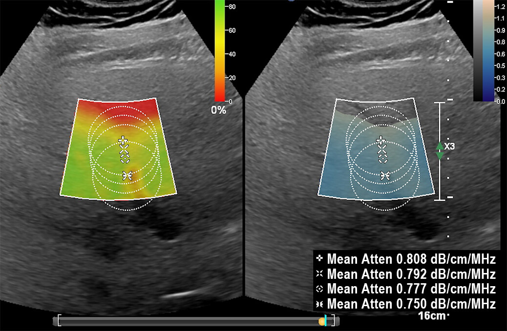 This study evaluates the impact of ROI depth, ROI size, and confidence map threshold on interobserver agreement and diagnostic performance of ultrasound attenuation coefficient measurements for hepatic steatosis.

ajronline.org/doi/10.2214/AJ…