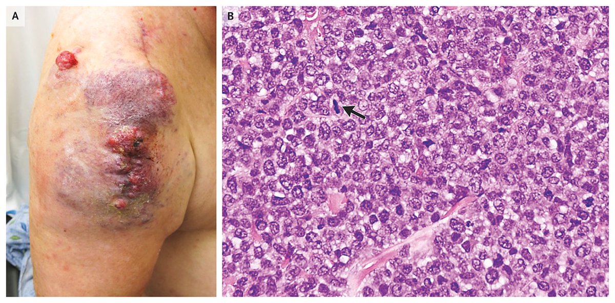 Images in Clinical Medicine: Cutaneous Extramedullary Plasmacytoma after Bone Fracture nej.md/3HMGYvw 

#DermTwitter