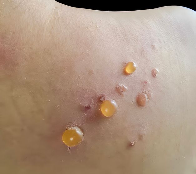 mydocwire's tweet image. 🚨 @US_FDA has approved #dupilumab for #bullouspemphigoid
🎯 18.3% achieved sustained remission
🧪 Less steroid use, less itch, better outcomes
🔗 buff.ly/VtfRuzH
#Dermatology #FDAapproval
