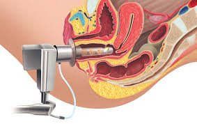 @VaginalLaser: Are we still experiencing #controversy?
 the Editor: : Menopause journals.lww.com/menopausejourn…