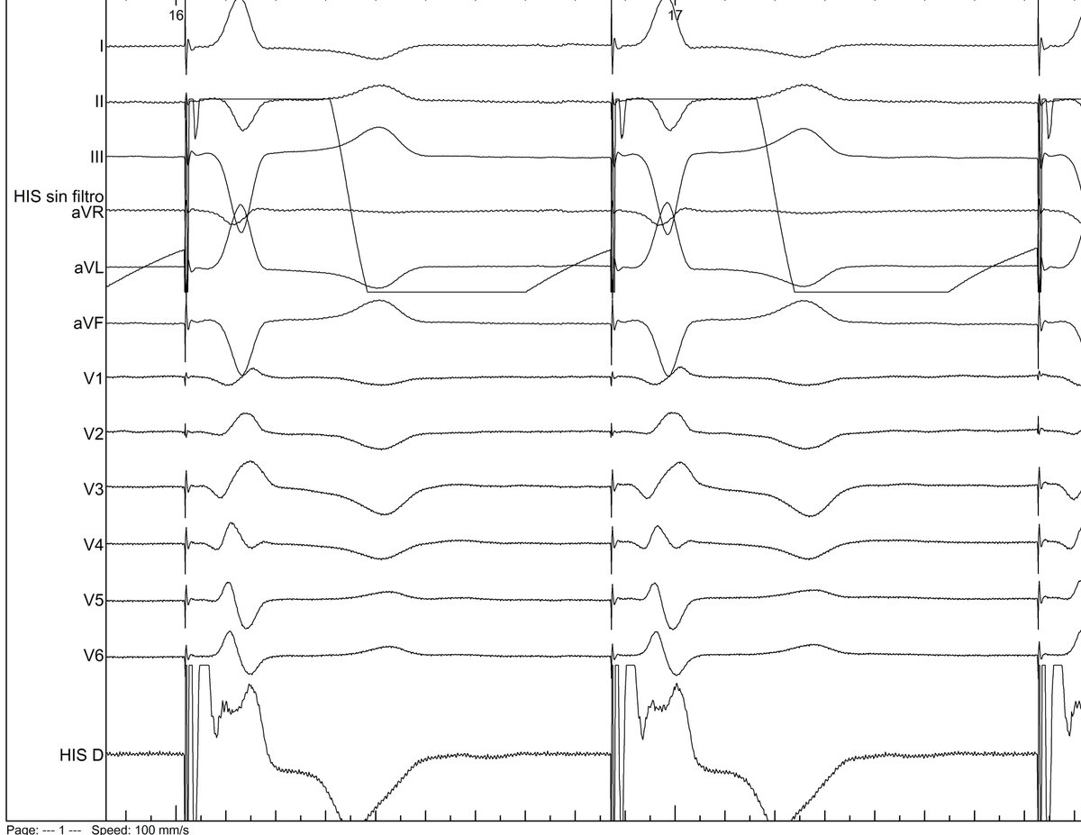 Dr. Pablo Moriña Vázquez (@dr_pmorina) on Twitter photo Patient with permanent atrial fibrillation and LBBB after TAVI. A pacemaker was implanted. HB capture was not possible. Which of these two CSP patterns would you prefer?<a href="/curilakarol/">curilakarol</a> <a href="/MdHuang/">Weijian Huang</a> <a href="/ManoloMolina8/">Manuel Molina-Lerma</a> <a href="/OCanoPerez/">Óscar Cano</a> Patient with permanent atrial fibrillation and LBBB after TAVI. A pacemaker was implanted. HB capture was not possible. Which of these two CSP patterns would you prefer?<a href="/curilakarol/">curilakarol</a> <a href="/MdHuang/">Weijian Huang</a> <a href="/ManoloMolina8/">Manuel Molina-Lerma</a> <a href="/OCanoPerez/">Óscar Cano</a>