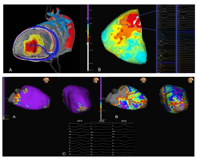 JICE_EP's tweet image. 🚨New #FreeRead in @JICE_EP
Epicardial VT Ablation with a Pentaspline Catheter during Left Ventricular Assist Device Placement
🧐📖rdcu.be/eujIH
by @JPayne_EP, Marshall Bell, Luke Cunningham & Sean Halleran
#EPeeps