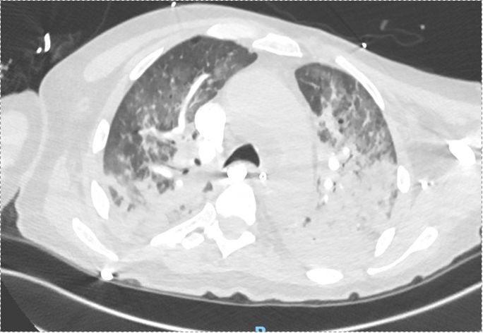 PulmPEEPs's tweet image. New fellows case files out today with University of Virginia !!
Great episode that spans respiratory failure, immunosuppressed patients, and undifferentiated shock.
Listen today! pulmpeeps.com/2025/07/01/103…