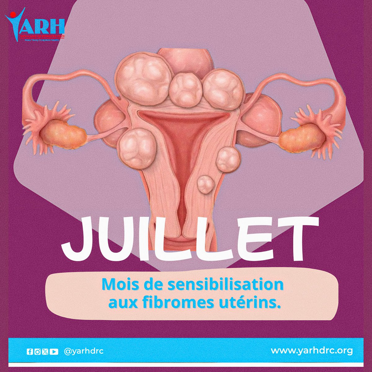 📅 Juillet : les fibromes utérins sont des tumeurs aux conséquences graves. 

🛑 1ère cause d’ablation de l’utérus
⚠️ 30-60 % des femmes sont touchées,particulièrement les noires 
⏰ Premiers diagnostics vers 25-30 ans

Brisons le silence!

#FibroidAwareness
#YARH4Impact