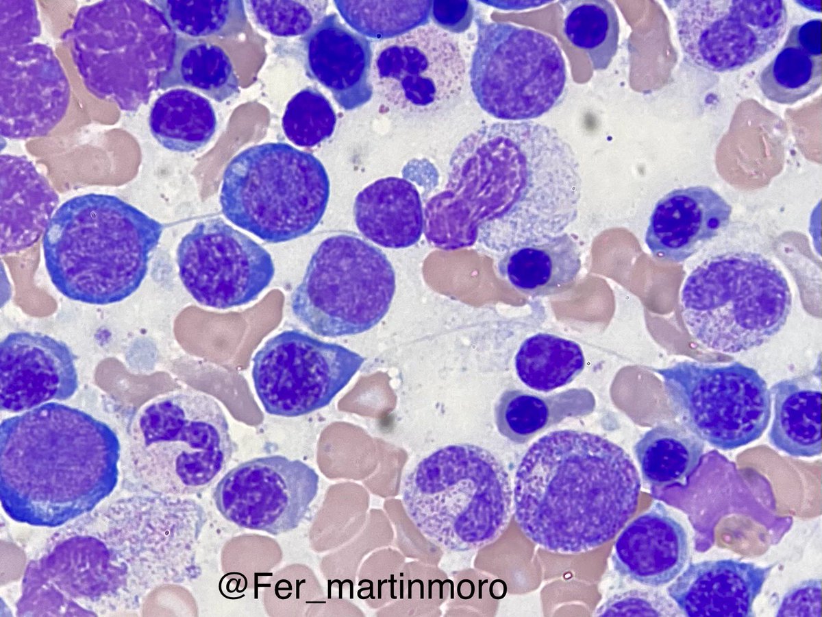 Building bridges to diagnosis #cytopath #hemepath
