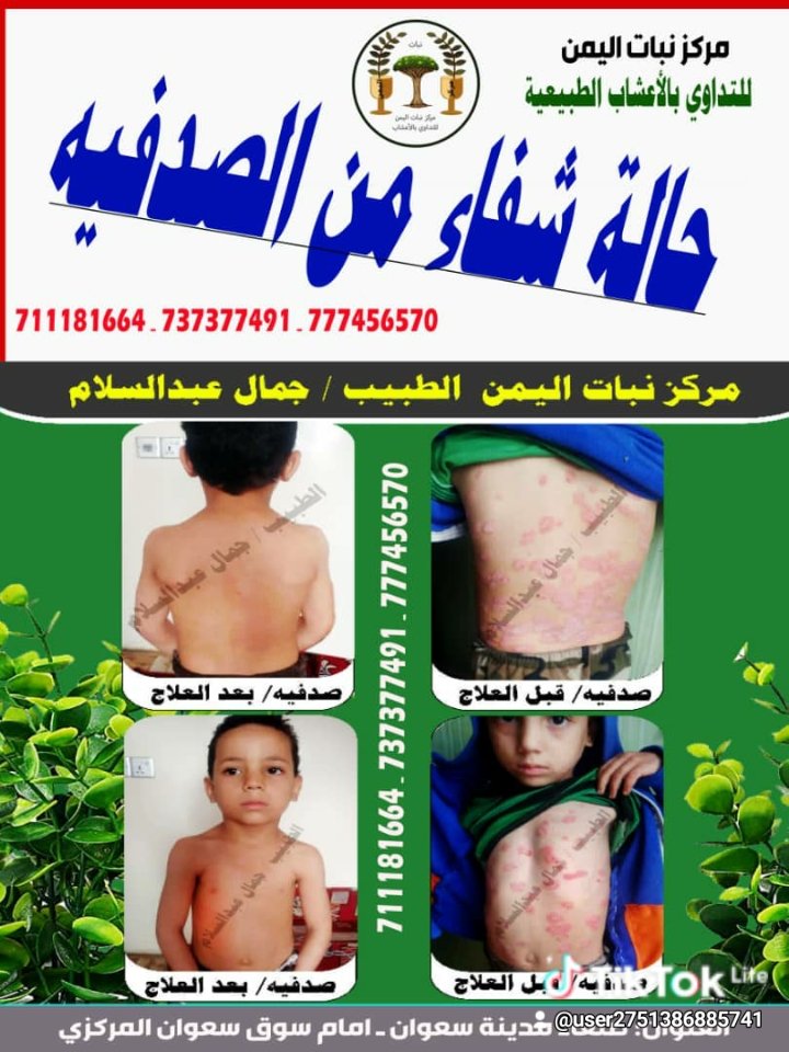 #فعال وناجح ومجرب ١٠٠٪لمرظى الصدفيه والامراض الجلديه بشكل عام في مركزنبات اليمن للتداوي بالاعشاب والنباتات الطبيعيه وملتزمين في حاله عدم الشفاء اعاده المبلغ الماخوذ والله على مانقول شهيد لمزيد من الاستفسار التواصل على هاتف وواتس 
00967777456570
او زياره صفحتنا على الفيس بوك