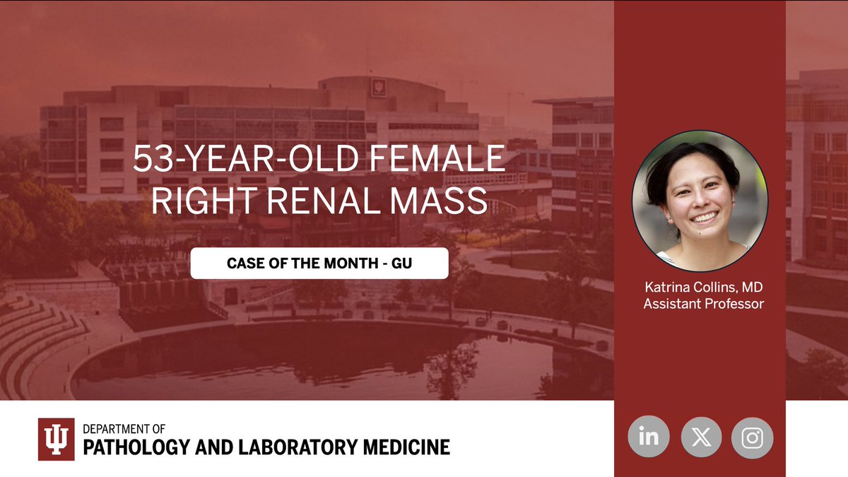 IUPathology (@iupathology) on Twitter photo 🆕 New Series Launch! 🚨
We're excited to launch our Case of the Month series—featuring unique and educational pathology cases.
Check out the first case and follow along each month! 🔬📅
#pathtwitter #medtwitter #gupath #COTM #iupathology <a href="/katcollmd/">Katrina Collins, MD || Pathologist</a>
🔗 medicine.iu.edu/pathology/educ… 🆕 New Series Launch! 🚨
We're excited to launch our Case of the Month series—featuring unique and educational pathology cases.
Check out the first case and follow along each month! 🔬📅
#pathtwitter #medtwitter #gupath #COTM #iupathology <a href="/katcollmd/">Katrina Collins, MD || Pathologist</a>
🔗 medicine.iu.edu/pathology/educ…