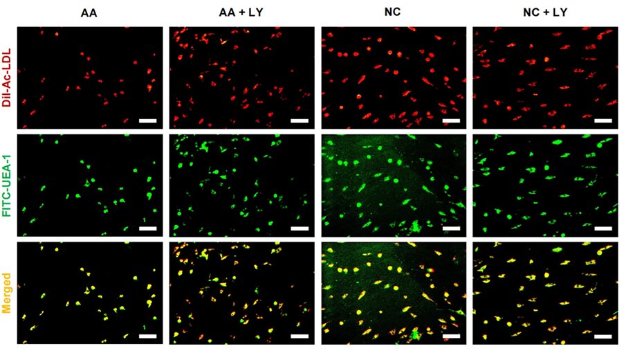 endothelialnews's tweet image. At Peking University, scientists found that TGF-尾 signaling is hyperactive in dysfunctional aplastic #anemia #endothelial progenitor cells with impaired #hematopoietic support and immune regulatory ability.
馃摑 go.nature.com/4kjv6Pl