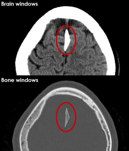 CT BRAIN 10: What is the structure ringed on this CT brain image? Answer buff.ly/3BZr9zl