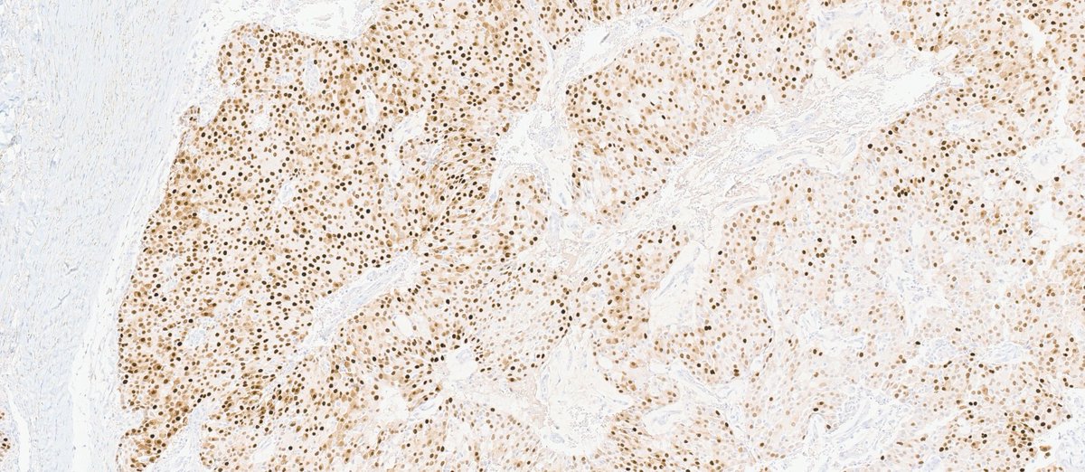 MhPathology's tweet image. Endocrine Mucin Producing Sweat Gland Carcinoma (EMPSCG)
-The closer you look, the LESS innocent it looks.
-A rare skin tumor, mostly occurs around eye, often misdiagnosed as Chalazion.
-INSM1+, Synaptophysin+, ER+, PR + and P63 is lost when becomes malignant.
#Mhpathology #CWRU