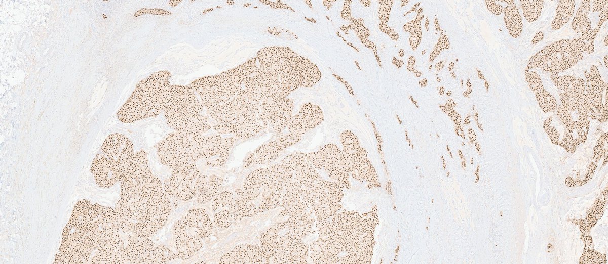 MhPathology's tweet image. Endocrine Mucin Producing Sweat Gland Carcinoma (EMPSCG)
-The closer you look, the LESS innocent it looks.
-A rare skin tumor, mostly occurs around eye, often misdiagnosed as Chalazion.
-INSM1+, Synaptophysin+, ER+, PR + and P63 is lost when becomes malignant.
#Mhpathology #CWRU