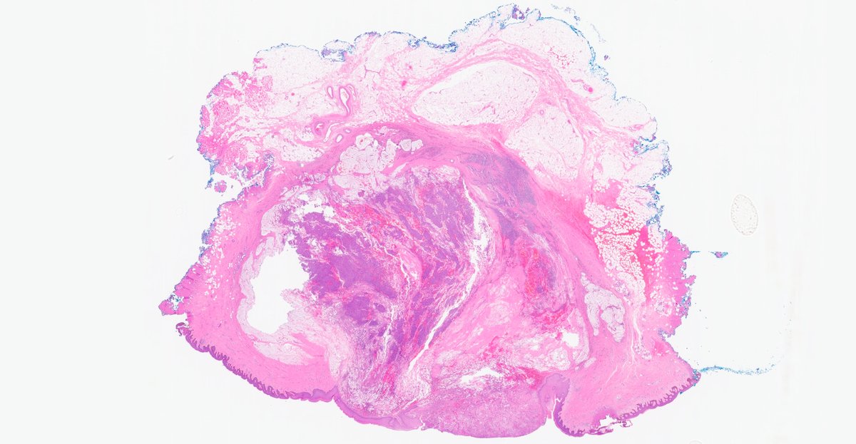 MhPathology's tweet image. Endocrine Mucin Producing Sweat Gland Carcinoma (EMPSCG)
-The closer you look, the LESS innocent it looks.
-A rare skin tumor, mostly occurs around eye, often misdiagnosed as Chalazion.
-INSM1+, Synaptophysin+, ER+, PR + and P63 is lost when becomes malignant.
#Mhpathology #CWRU