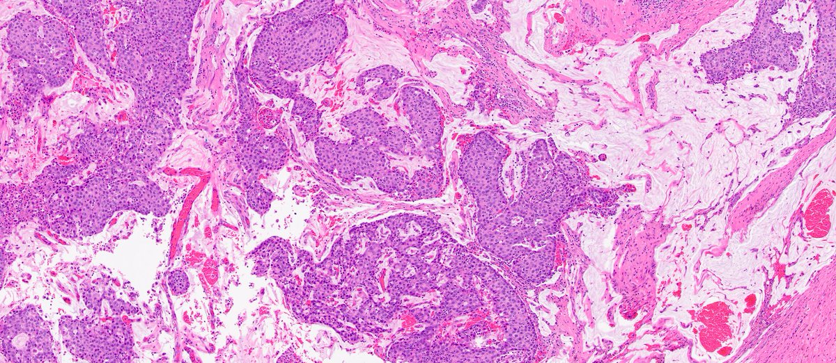 MhPathology's tweet image. Endocrine Mucin Producing Sweat Gland Carcinoma (EMPSCG)
-The closer you look, the LESS innocent it looks.
-A rare skin tumor, mostly occurs around eye, often misdiagnosed as Chalazion.
-INSM1+, Synaptophysin+, ER+, PR + and P63 is lost when becomes malignant.
#Mhpathology #CWRU