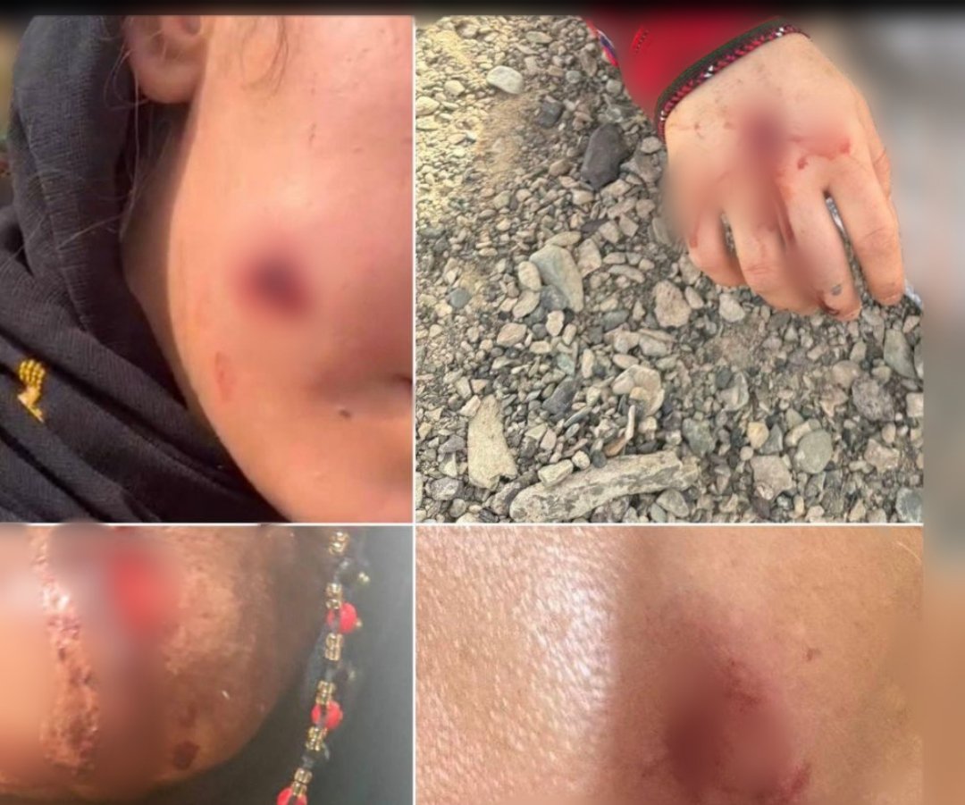 hamalilalin's tweet image. این تصویر گلوله‌هایی‌ست که امروز بر صورت و دست‌های زنان بلوچ نشست! 

امروز در گونیچ، نیروهای اشغالگر به جای پاسخ، گلوله دادند.
و این زنان، در برابر شلیک‌ها فریاد زدند:
«نمی‌میریم، بزن!»

این صدای ملت بلوچ است. صدایی که با گلوله خاموش نمی‌شود

 #گونیچ
 #StopKillingBaluch