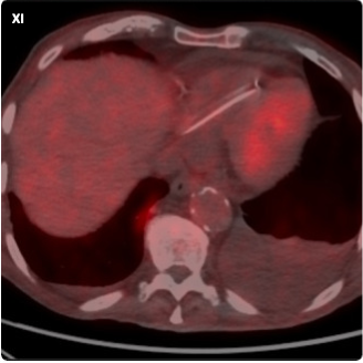 InvasiveCardiol's tweet image. New in Early View ➡️ Pocket Erosion in a Patient With Bullous Pemphigoid: A Dual Dermatologic and Device-Related Challenge hubs.ly/Q03vtHcm0
@DLBHATTMD #cardioTwitter #cardioX #cardiology #interventionalcardiology