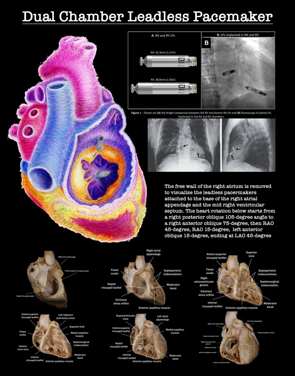 HeartAttaq's tweet photo. Dual Chamber Leadless Pacemaker 

Abbott Aveir 

Made this as a map to help people conceptualize the directionality of these new pacemakers. The X-rays show and AP projection, steep RAO and LAO while the drawing helps us visualize the implants from a posterior view. https://t.co/HHkHIBFa3l