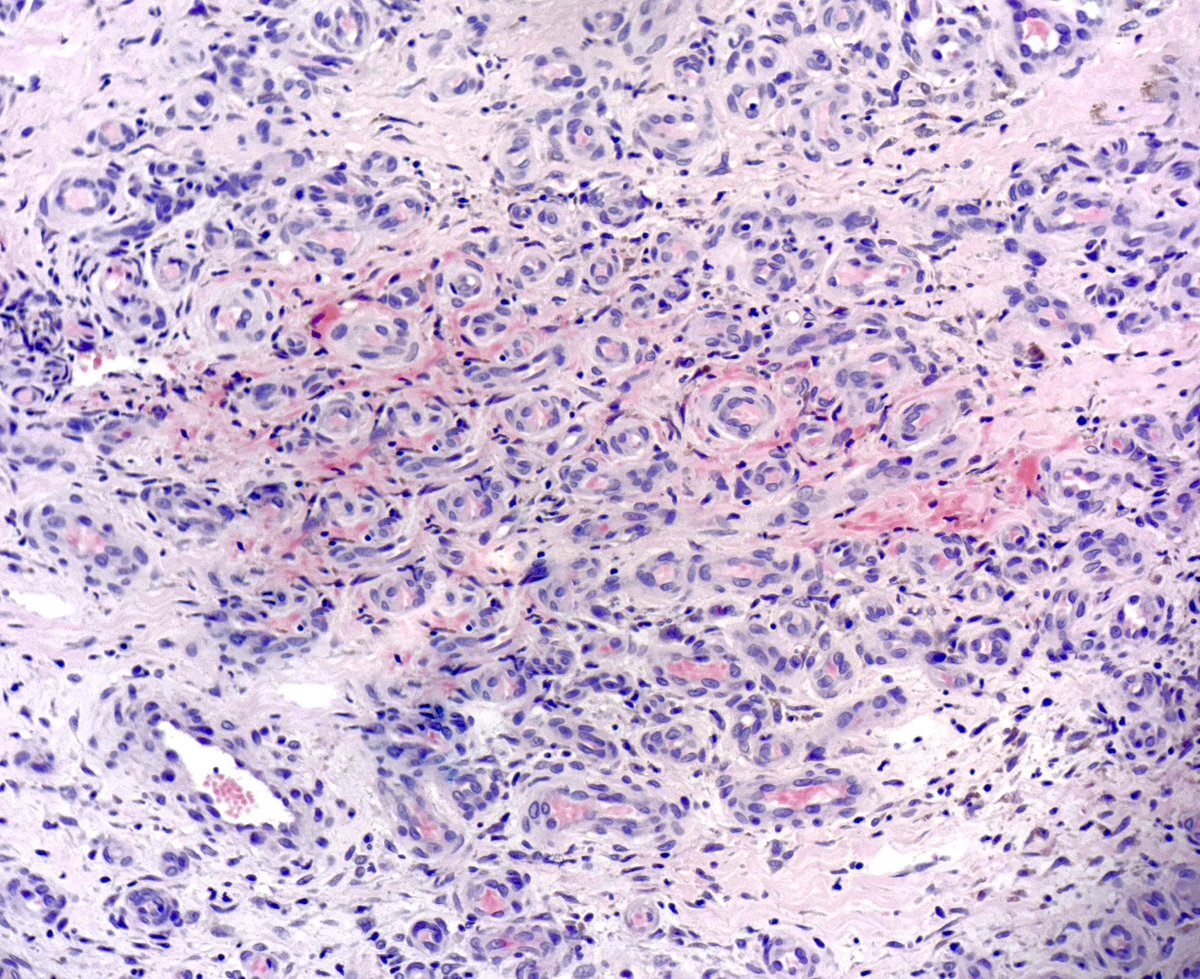 MBBS_Pathology's tweet image. #StasisDermatitis
Proliferating vessels in the dermis
Red blood cell extravasation
Haemosiderin-laden macrophages
Perivascular fibrin
#dermatology
#pathology
😉