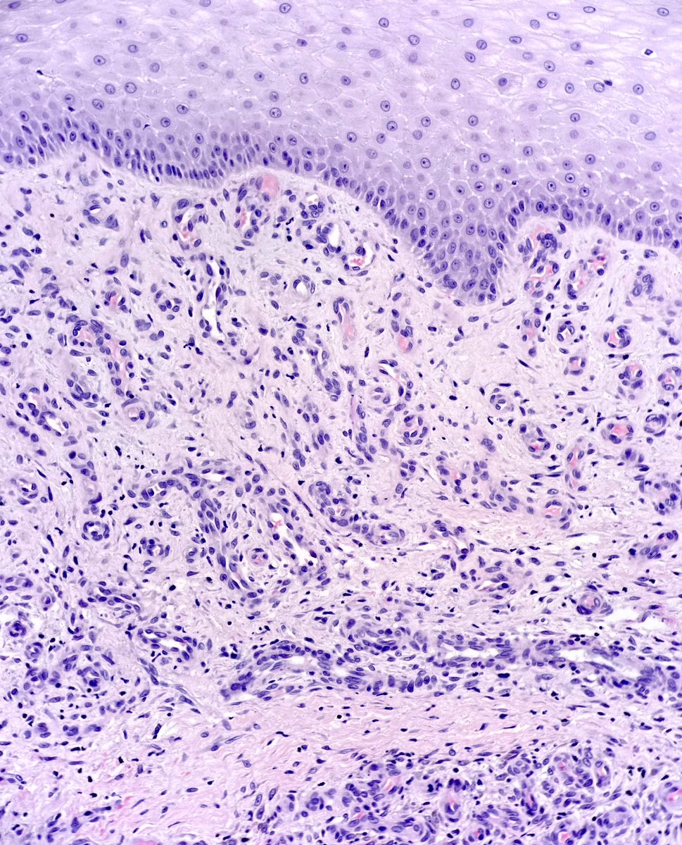 MBBS_Pathology's tweet image. #StasisDermatitis
Proliferating vessels in the dermis
Red blood cell extravasation
Haemosiderin-laden macrophages
Perivascular fibrin
#dermatology
#pathology
😉