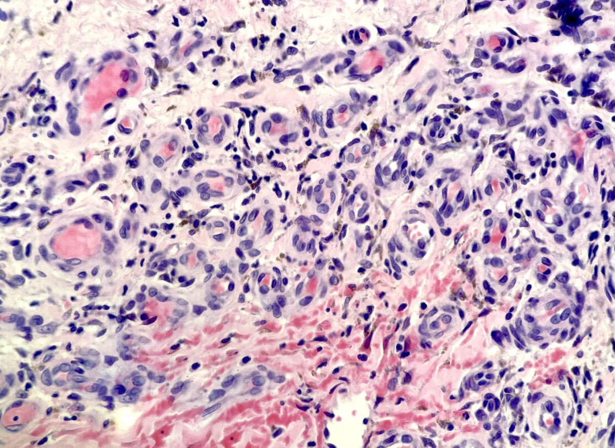 MBBS_Pathology's tweet image. #StasisDermatitis
Proliferating vessels in the dermis
Red blood cell extravasation
Haemosiderin-laden macrophages
Perivascular fibrin
#dermatology
#pathology
😉