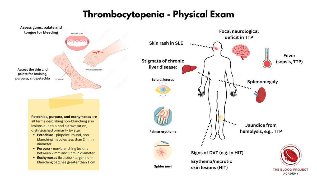 PHYSICAL EXAM IN THROMBOCYTOPENIA

May offer key clues in thrombocytopenia:

Petechiae &amp; purpura → low platelets
Bleeding gums → severe thrombocytopenia
Neuro signs → think TTP
Fever → consider TTP or infection 
Splenomegaly → cirrhosis or cancer

#MedTwitter #HemeTwitter