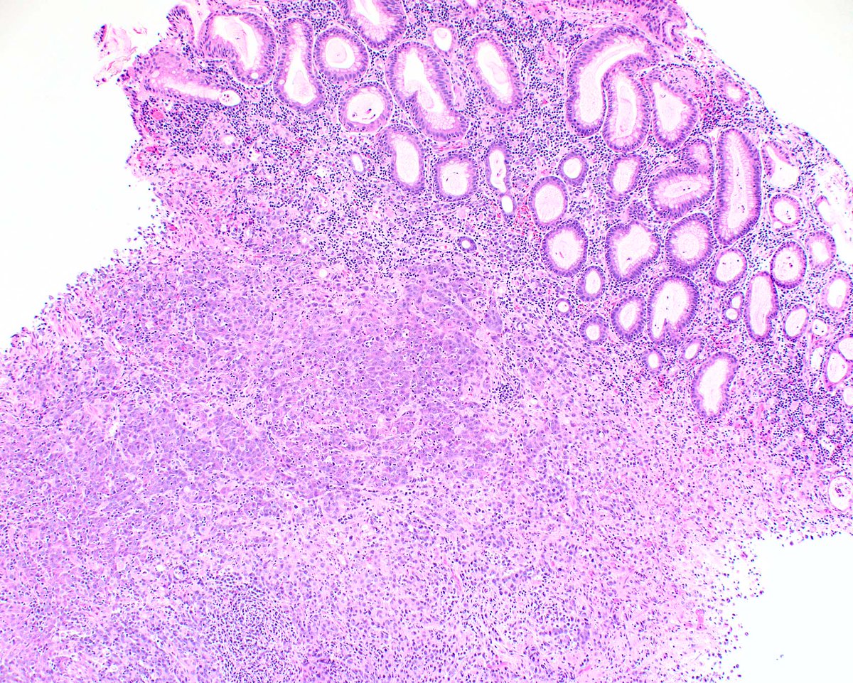 ModernPathology's tweet image. The more T cells in EBV-related gastric carcinoma, the merrier for the patient.  This one has both squamous and glandular differentiation.
Soeratram TTD, Biesma HD, Egthuijsen JMP, Meershoek-Klein Kranenbarg E, Hartgrink HH, van de Velde CJH, Mookhoek A, van Dijk E, Kim Y, Ylstra…