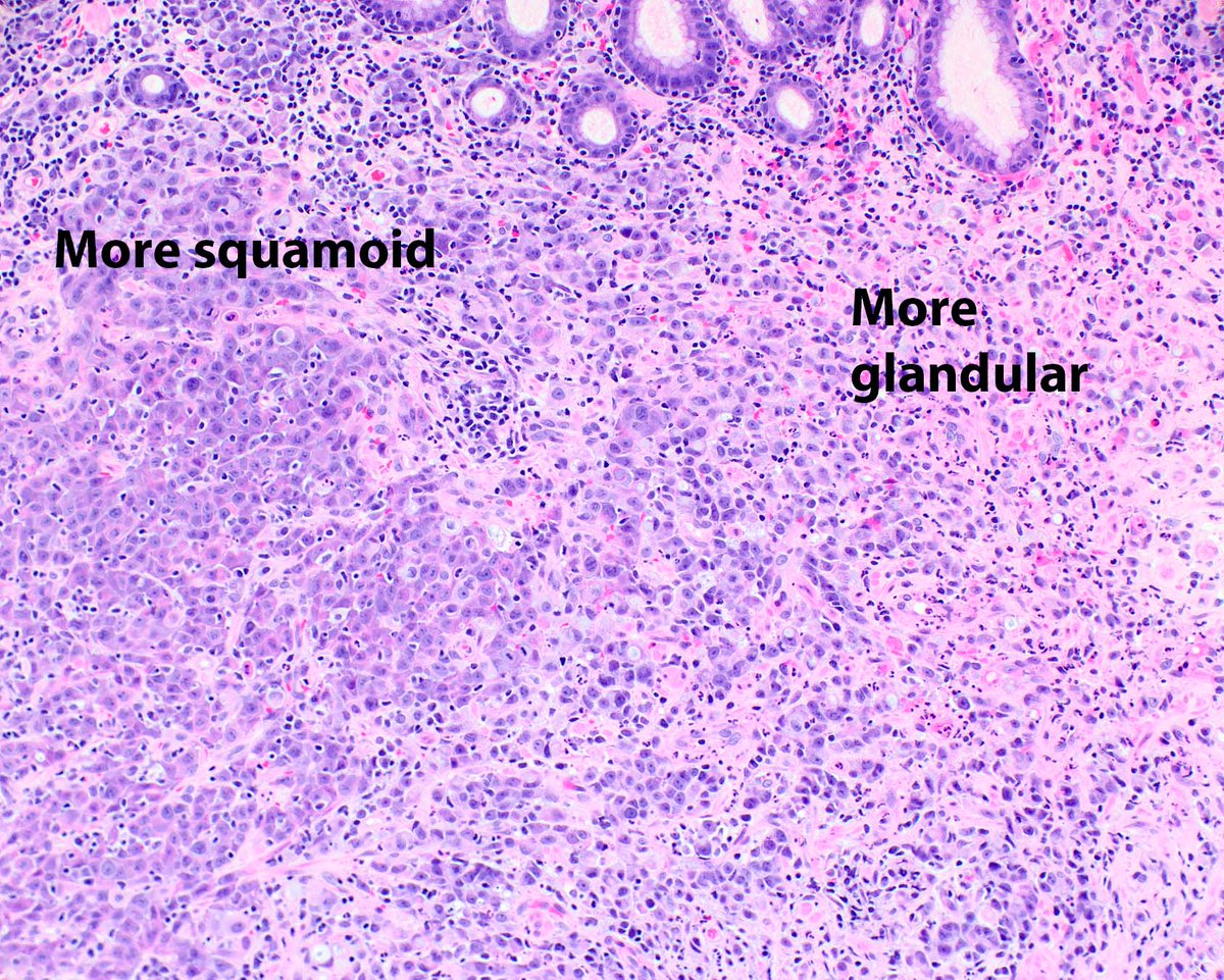 ModernPathology's tweet image. The more T cells in EBV-related gastric carcinoma, the merrier for the patient.  This one has both squamous and glandular differentiation.
Soeratram TTD, Biesma HD, Egthuijsen JMP, Meershoek-Klein Kranenbarg E, Hartgrink HH, van de Velde CJH, Mookhoek A, van Dijk E, Kim Y, Ylstra…
