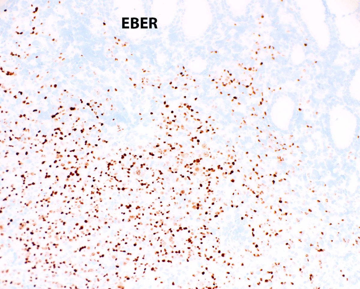 ModernPathology's tweet image. The more T cells in EBV-related gastric carcinoma, the merrier for the patient.  This one has both squamous and glandular differentiation.
Soeratram TTD, Biesma HD, Egthuijsen JMP, Meershoek-Klein Kranenbarg E, Hartgrink HH, van de Velde CJH, Mookhoek A, van Dijk E, Kim Y, Ylstra…