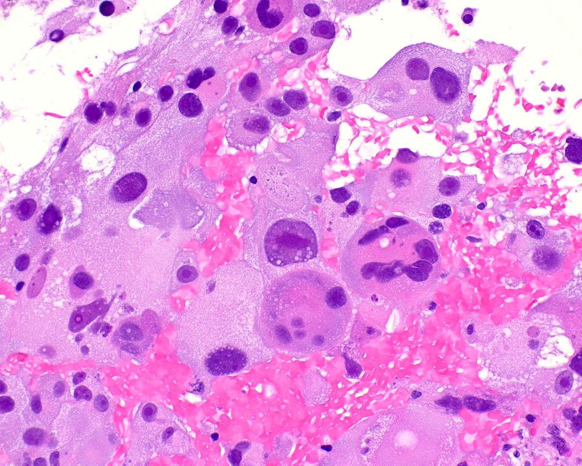 This spectacular metastatic dedifferentiated gastrointestinal stromal tumor to the liver mimics hepatocellular carcinoma.