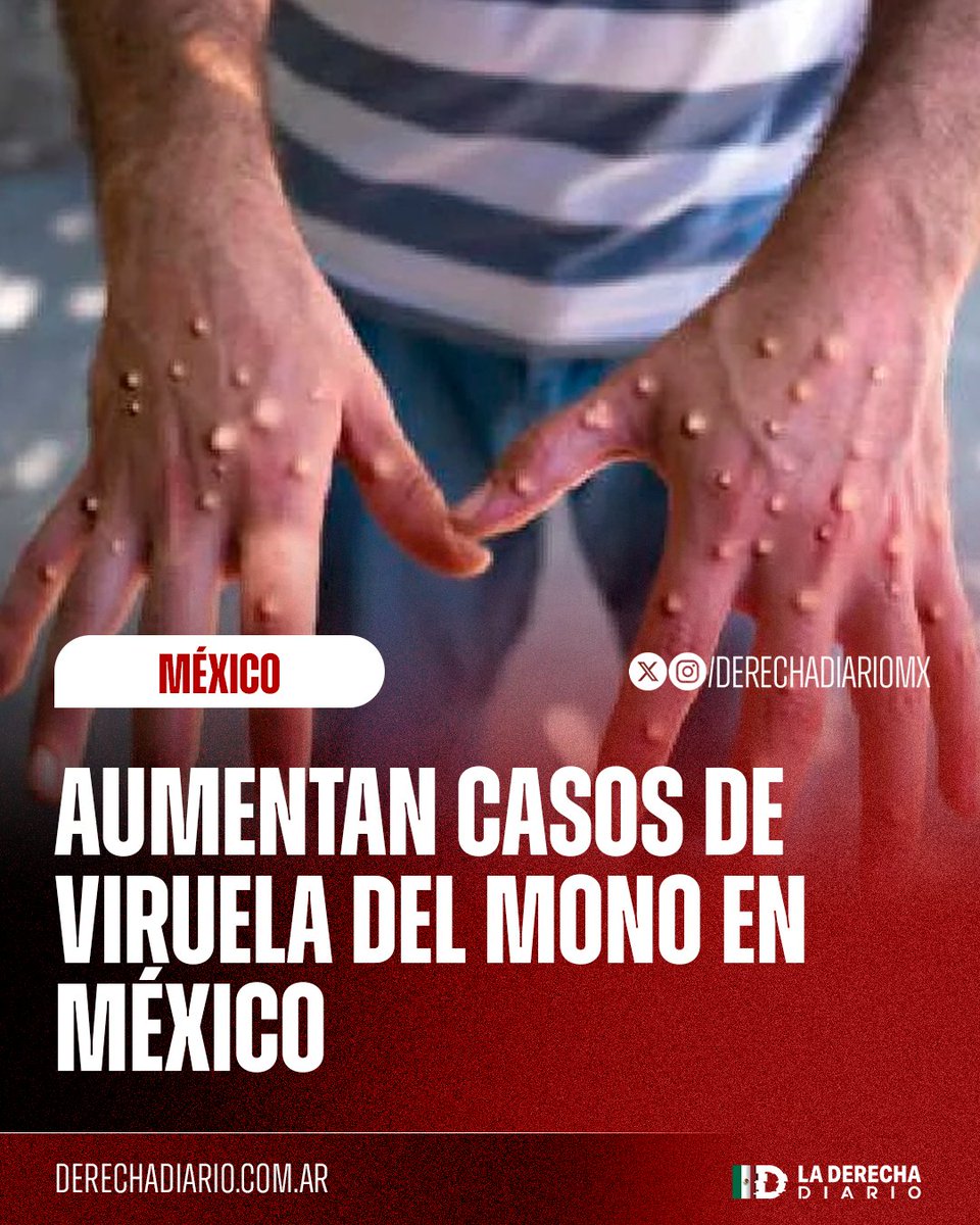 🚨🇲🇽 | México registra un alarmante incremento de afectados por viruela del mono con 345 casos registrados: Jalisco y la Ciudad de México son las entidades con más casos registrados.