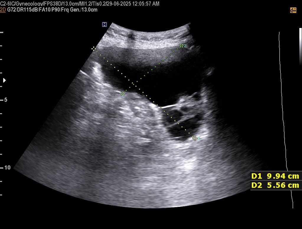 EchoTech_4's tweet image. Ovarian cystadenocarcinoma and pseudomyxoma peritonie proved by histopathology.

#EchoTech