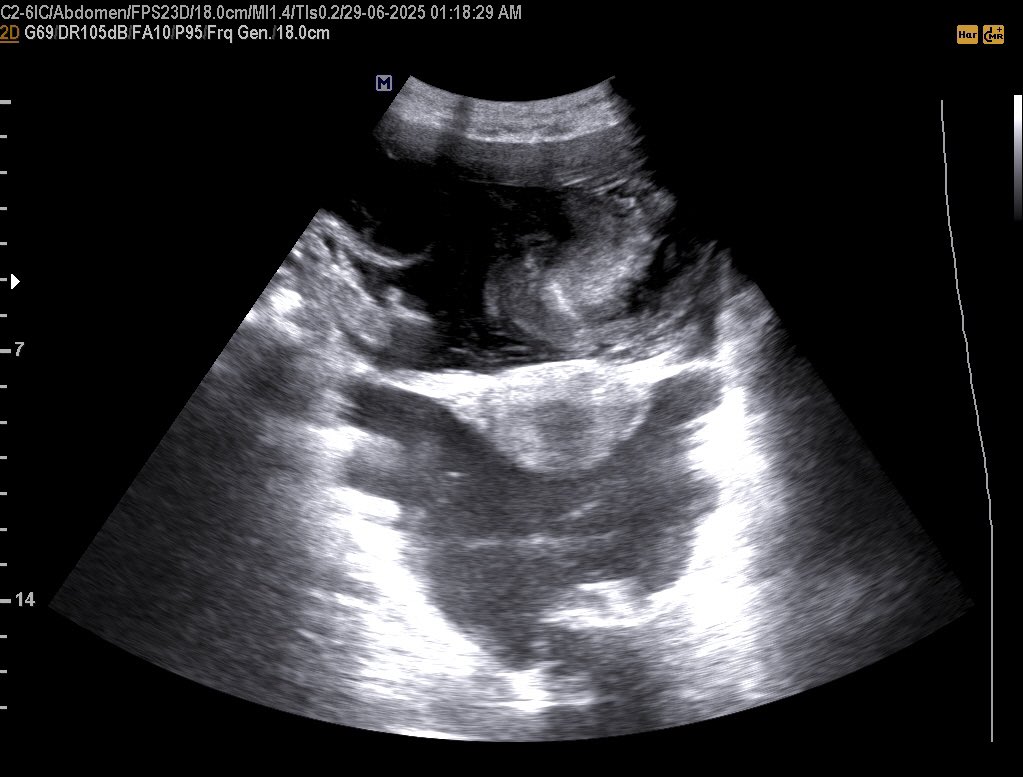 EchoTech_4's tweet image. Ovarian cystadenocarcinoma and pseudomyxoma peritonie proved by histopathology.

#EchoTech