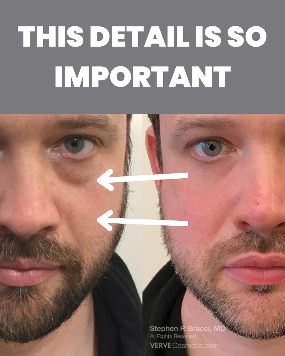 VerveCosmetics's tweet photo. Many articles on under-eye fillers for eye bags lack crucial details. To bridge this gap, Dr. Stephen P. Bracci, a seasoned expert with 25 years of experience in aesthetics, provides comprehensive insights. 
Discover the missing facts here: [Link] https://t.co/7J6YCaxI1y https://t.co/fxdCeAG9Hy