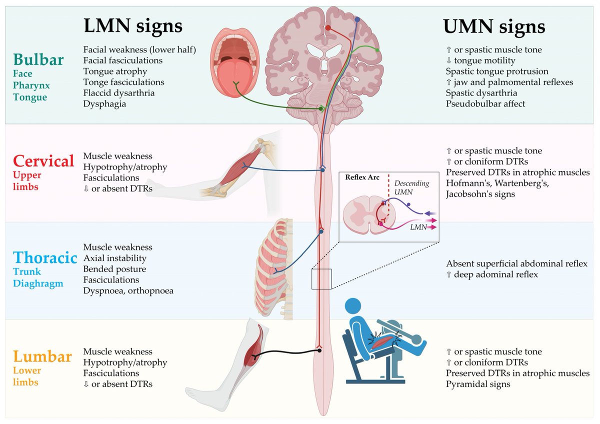 Scott C. Howard (@schowardjd) on Twitter photo <a href="/drkeithsiau/">Keith Siau</a> Progressive weakness & dysphagia and 📹 tongue fasciculations, scalloping, & atrophy ➡️ suspected ALS
Clinical signs of UMN & LMN involvement according to each of the body regions 👇🏼
<Image source: @EncyclopediaMD1, tinyurl.com/2fzxnehe> <a href="/drkeithsiau/">Keith Siau</a> Progressive weakness & dysphagia and 📹 tongue fasciculations, scalloping, & atrophy ➡️ suspected ALS
Clinical signs of UMN & LMN involvement according to each of the body regions 👇🏼
<Image source: @EncyclopediaMD1, tinyurl.com/2fzxnehe>