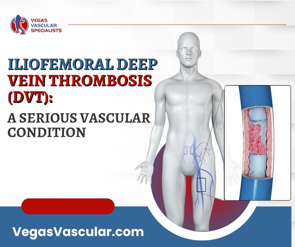 An abdominal aortic aneurysm (AAA) is a bulge in the abdominal aorta, the largest artery carrying blood from the heart to the lower body. Without treatment, an AAA can rupture, leading to a medical emergency and potential internal bleeding. 🚑

Read here: vegasvascular.com/abdominal-aort…