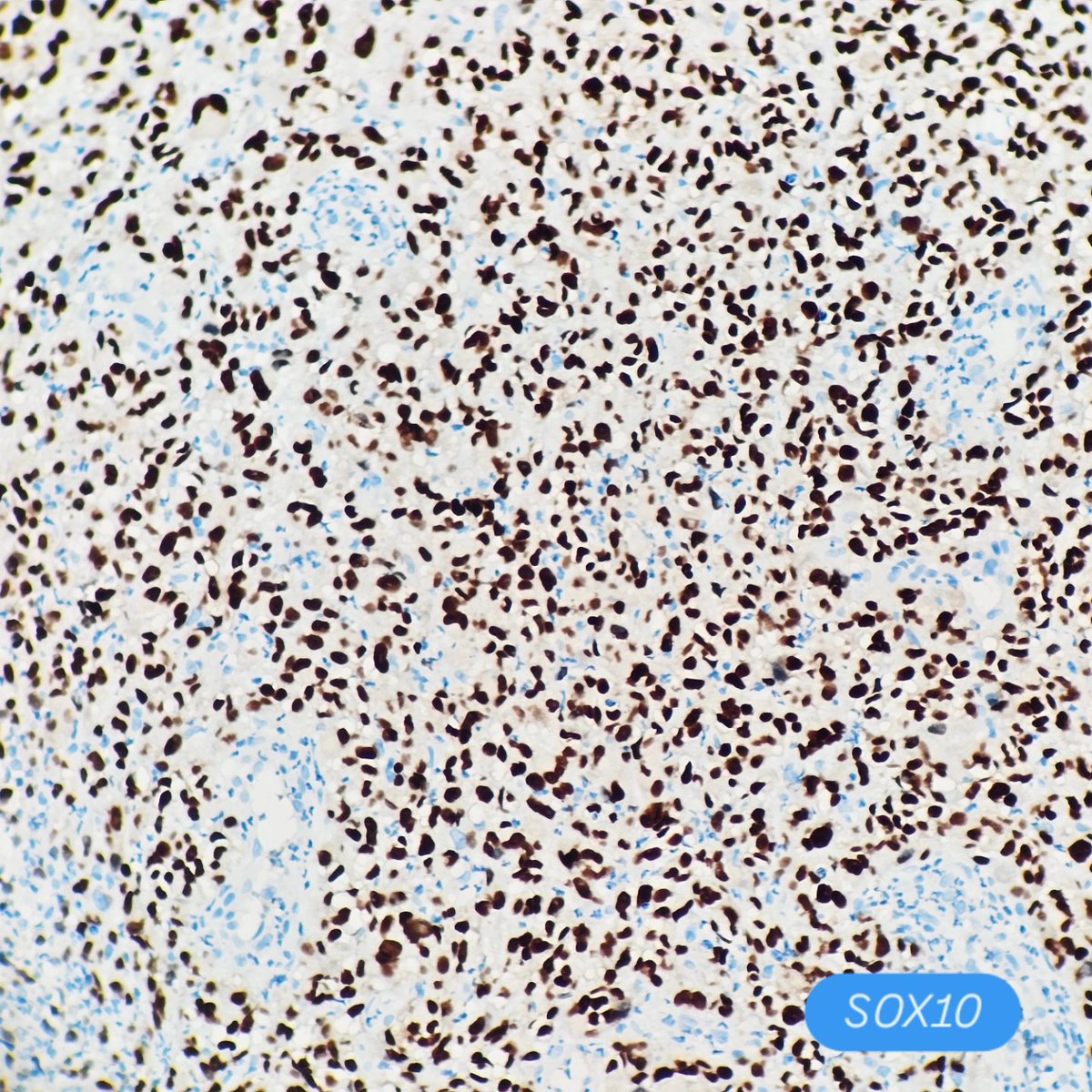 Pathologist = Detective. Always.
Rectal biopsy… turned out to be a melanoma.
Pigmentation in disguise — subtle but real.
Diagnosis confirmed with SOX10, S100, and HMB-45.
📸 Details in the images.
Trust the morphology. Follow the clues.
#Pathology #Melanoma #GIpath #pathologist