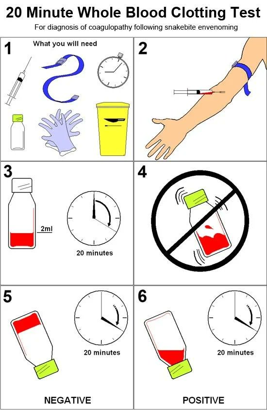 Fong Voon Ken (@ironken6) on Twitter photo 17/ How to Do the 20-Minute Whole Blood Clotting Test (20WBCT)?
Put 1–2 mL venous blood in a clean, dry glass tube
Wait 20 mins
Tilt the tube
🧪 Clotted = negative
💉 Liquid = positive → give antivenom
#WorldSnakeDay
who.int/teams/control-… 17/ How to Do the 20-Minute Whole Blood Clotting Test (20WBCT)?
Put 1–2 mL venous blood in a clean, dry glass tube
Wait 20 mins
Tilt the tube
🧪 Clotted = negative
💉 Liquid = positive → give antivenom
#WorldSnakeDay
who.int/teams/control-…