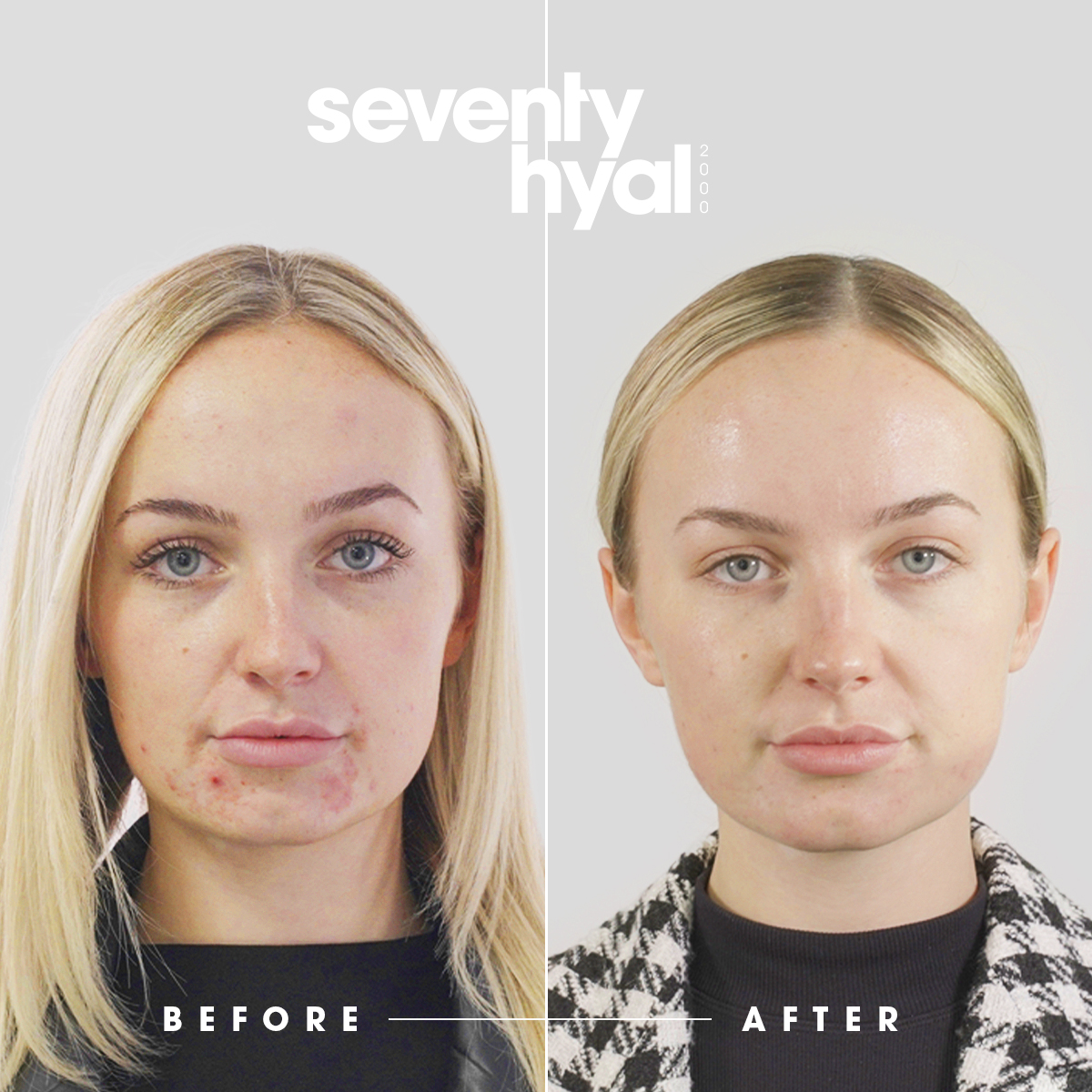 From Breakouts to Brilliance – Try Seventy Hyal Today! - mailchi.mp/b324203fffb1/f…
Hydrated skin = calmer, clearer skin. Seventy Hyal doesn’t just give a glow — it supports your skin’s natural ability to repair and protect itself from future breakouts.