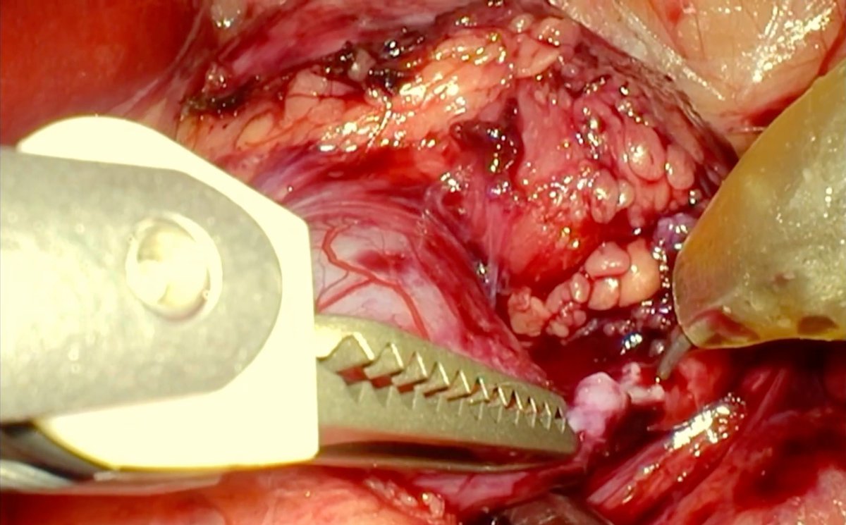 youtu.be/IgAWHnUMf4E

14 months baby , robotic pyeloplasty , done live RUFCON. Sharing nut shell video 
youtu.be/IgAWHnUMf4E