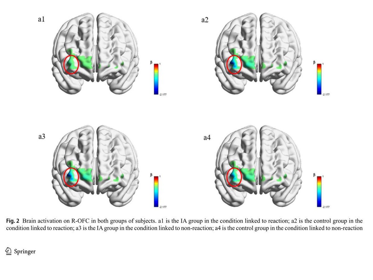 NIRx_NIRS's tweet image. Zhao et al. (2025) used #fNIRS to reveal stronger inhibitory devaluation effects in people with #InternetAddiction, alongside greater ROFC activation and OFC–DLPFC connectivity.
🧠 Suggests altered inhibitory control mechanisms.
🔗 doi.org/10.1007/s12144…