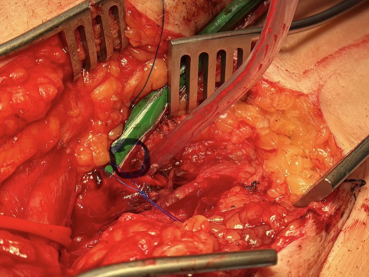 chris_malkin4's tweet image. How easy is it to remove large Octacor 32mm #tavi from python sheath? We could not cross the arch but we could not remove it- with cells of valve pushing out of the expandable fold of the python. Surgical assistance and able to complete procedure- any experience or data??