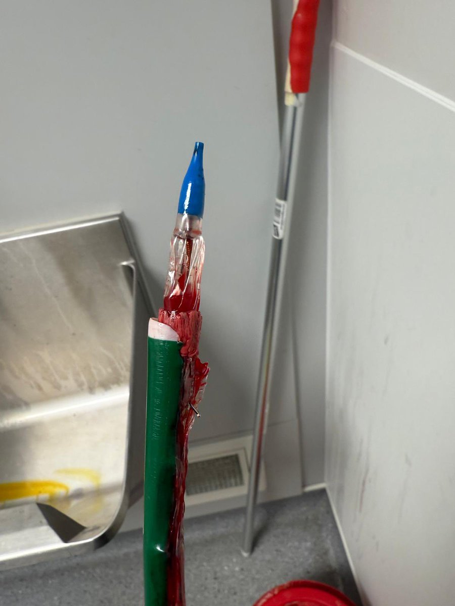 chris_malkin4's tweet image. How easy is it to remove large Octacor 32mm #tavi from python sheath? We could not cross the arch but we could not remove it- with cells of valve pushing out of the expandable fold of the python. Surgical assistance and able to complete procedure- any experience or data??